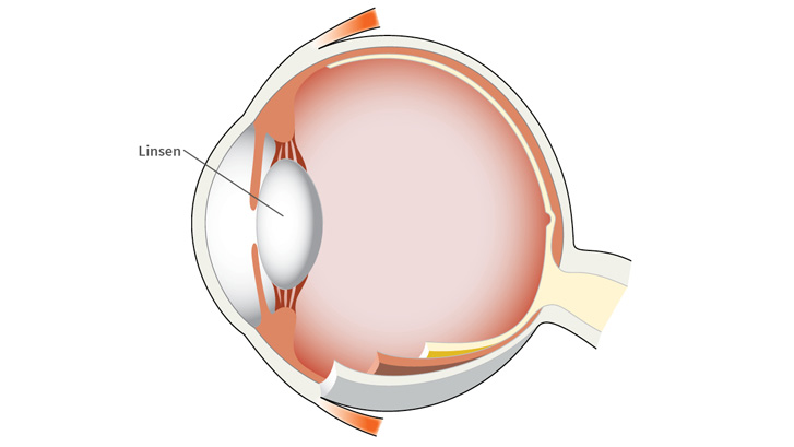 Linsen anpassar ögats fokus på nära håll.