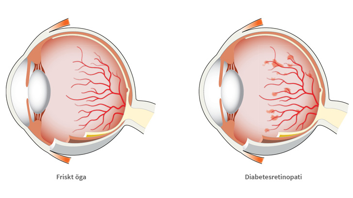 Diabetesretinopati kan orsaka blödningar i näthinnan.