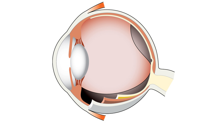 Glaskroppsavlossning innebär att glaskroppen lossnar från sina fästen mot näthinnan.