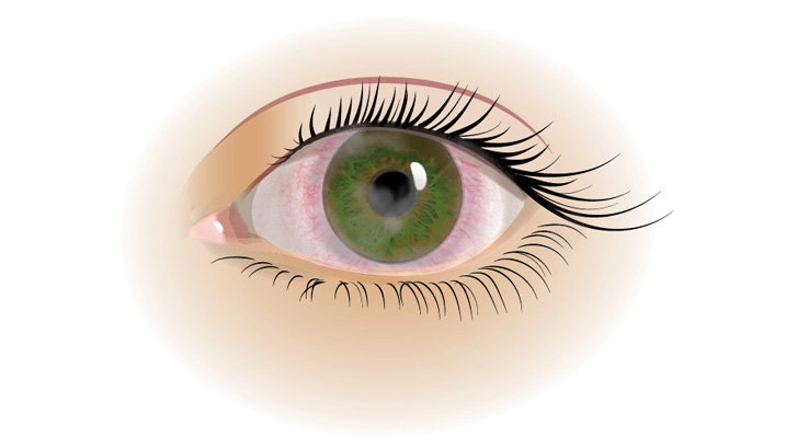 Keratit är en inflammation i ögats hornhinna som kan göra ögat rött och vara mycket smärtsamt.