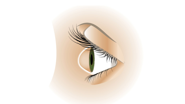 Keratokonus gör att hornhinnan får en toppig form.