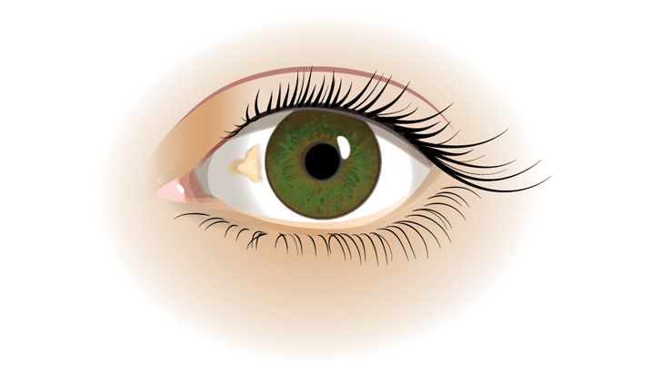 Pinguecula ser ut som en gulaktig fläck eller bula på ögonvitan.